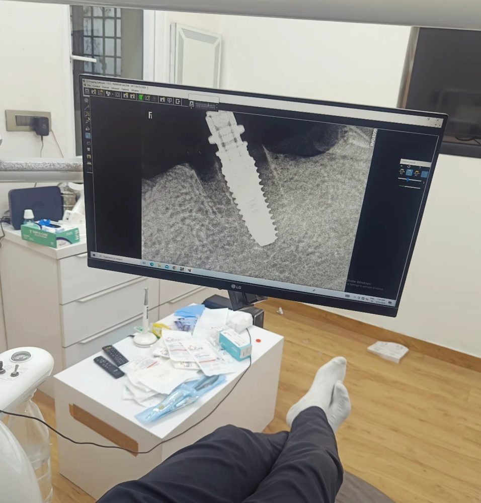 Dental implant shown on the clinic's digital X-ray imaging screen at Global Dental Care, Dehradun