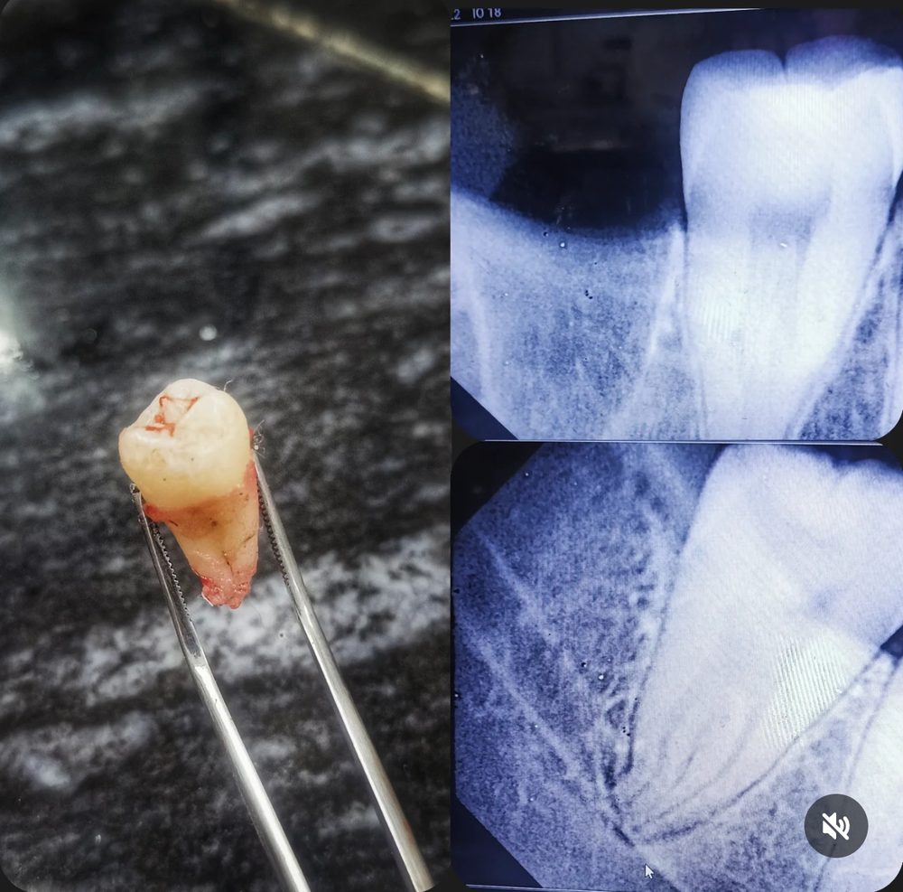 A cleanly extracted molar beside its pre-operative dental X-rays