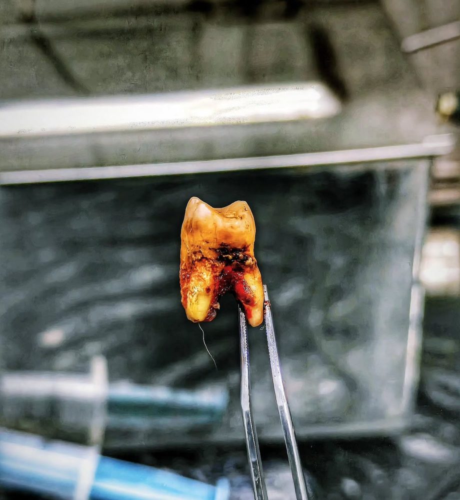 Close-up of a deeply decayed molar after an atraumatic extraction